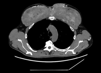 Misterul Muscular: Când Corpul Depozitează Calciu în Mușchi 0 (0)