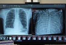 Plămâni Artificiali Salvează Viața unui Pacient Așteptând Transplantul