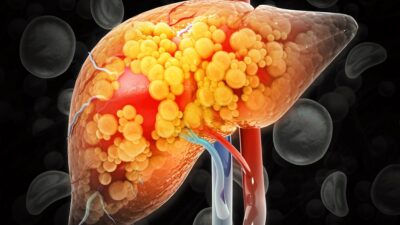 Fat-on-liver-400x225