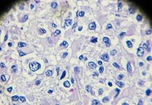 Biopsia Lichidă: O Nouă Speranță în Optimizarea Tratamentului cu Chimioterapie de Mare Doză pentru Tumori Germinale