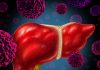 Descoperire Revoluționară: Cum Congestia Hepatică Poate Conduce la Fibroză și Cancer Hepatic