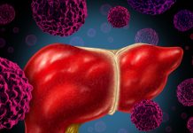 Descoperire Revoluționară: Cum Congestia Hepatică Poate Conduce la Fibroză și Cancer Hepatic