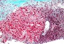 Reducerea Consumului de Proteine în Dietă Ar Putea Preveni Dezvoltarea Cancerului Hepatic la Pacienții cu Risc