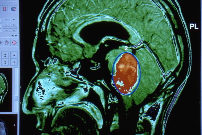 BrainCancerMRI-523738898-scaled