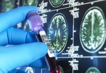 Biomarkerii din sânge pentru Alzheimer și degenerescența lobului frontal, validați în America Latină