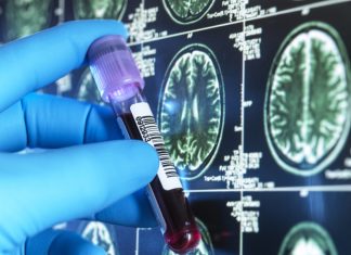 Biomarkerii din sânge pentru Alzheimer și degenerescența lobului frontal, validați în America Latină 0 (0)