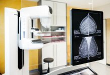 Descoperire Majoră în Lupta cu Cancerul Mamar Metastatic: Supraviețuirea la 10 Ani Crește de la 20% la 60% datorită Screeningului