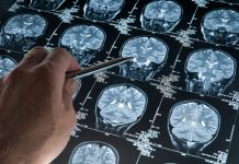 Inteligența Artificială care Analizează RMN-uri Cerebrale în Secunde Poate Revoluționa Îngrijirea Neurologică