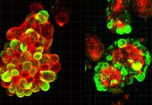 Cum Utilizează Cancerul Ovarian Celulele Sănătoase pentru a se Răspândi Rapid