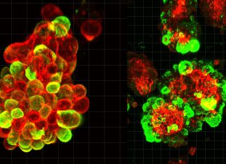 Cum Utilizează Cancerul Ovarian Celulele Sănătoase pentru a se Răspândi Rapid 0 (0)