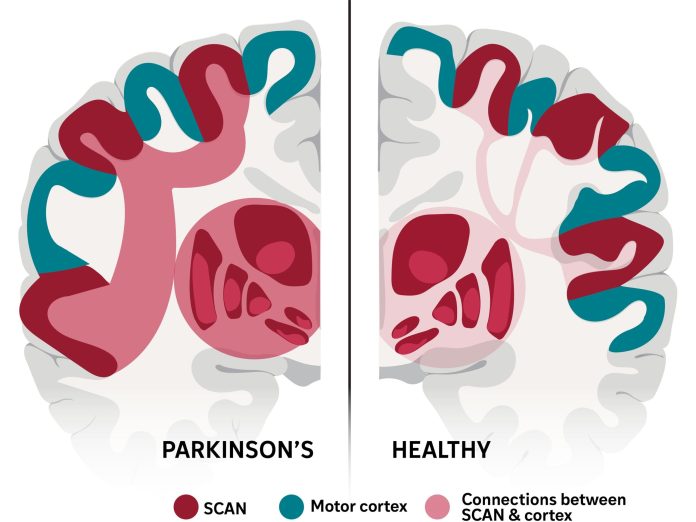WashU-Medicine-SCAN-Parkinsons-disease