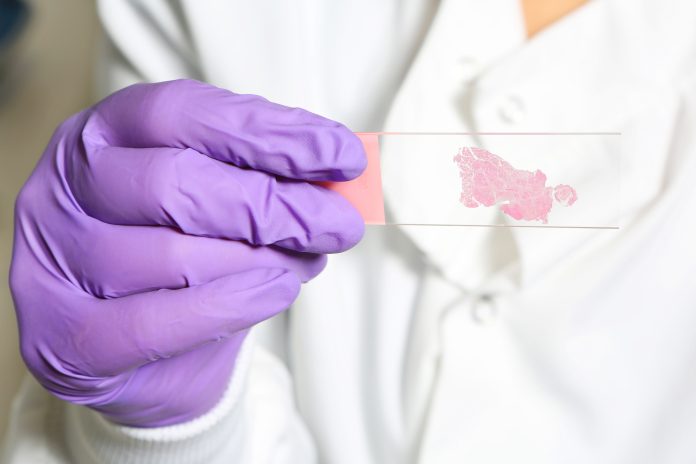 breast-cancer-tumor-555855661