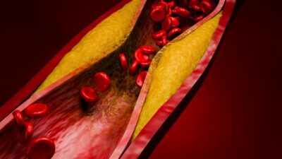 Clogged-artery-400x225