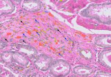 Atlasul Celular al Cancerului de Prostată Dezvăluie Limitele Diagnosticării Actuale