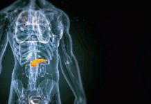 Biomarkerii HRD în Cancerul Pancreatic Metastatic Deschid Calea către Imunoterapia de Precizie