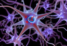 Progresul Rapid al Alzheimerului la Femei, Legat de un Marker al Parkinsonului