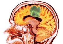 Rata de Supraviețuire în Cancerele Avansate ale Creierului se Dublează cu Terapia Laser Interstițială Termică