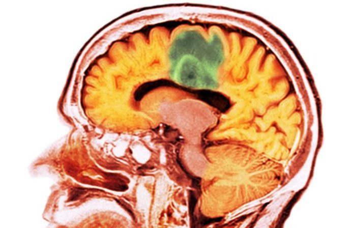 Getty_1128676746_glioblastoma