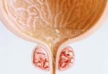 Noi Perspective în Tratamentul Cancerului de Prostată Metastatic prin Testarea Secvențială a ctADN