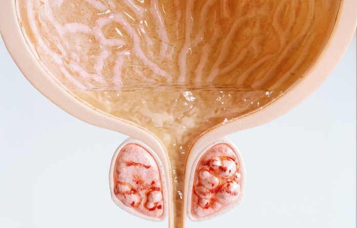 Getty_1405994039_ProstateCancer