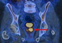Imagistica Moleculară Reduce la Jumătate Numărul de Biopsii în Cancerele de Prostată: Succese în Studiul Clinic de Fază III