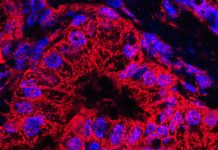 Inhibitorii KRAS – Noua Frontieră în Prevenirea Cancerului Pancreatic