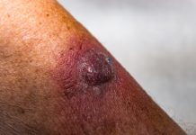 Crema de piele care activează imunitatea ar putea suprima carcinomul cu celule scuamoase