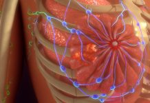 Inteligența Artificială Revoluționează Tratamentul Cancerului de Sân Prin Evaluarea Automată a Biopsiilor