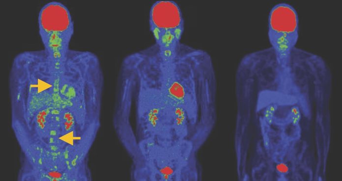Gattinoni_CAR_T_Cell_PET-scan_NIH