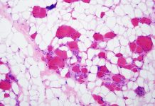 Toxicitatea ARN-ului Contribuie la Bolile de Inimă în Distrofia Musculară