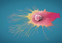 Variante Rare de Cancer la Sân Dezvăluie Legături Specifice Ancestrale pentru Debutul Timpuriu