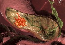 Descoperirea Mecanismelor Metabolice din Spatele Cancerului Pancreatic