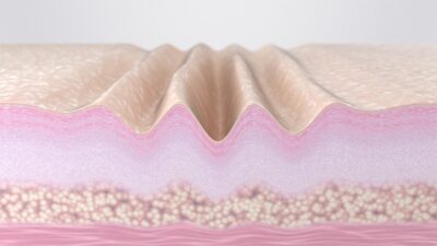 Wrinkled-skin-400x225