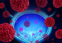 Nou Test Urinar de Predicție a Recidivelor în Cancerul de Vezică