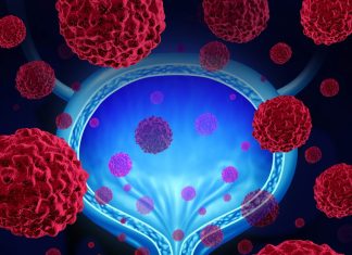 Nou Test Urinar de Predicție a Recidivelor în Cancerul de Vezică 5 (1)
