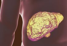 Terapia celulară ar putea reduce necesitatea transplantului hepatic în cazuri avansate de ciroză