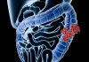 Adenomii precanceroși modifică microbiomul intestinal pe termen lung