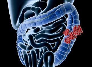 Adenomii precanceroși modifică microbiomul intestinal pe termen lung 0 (0)