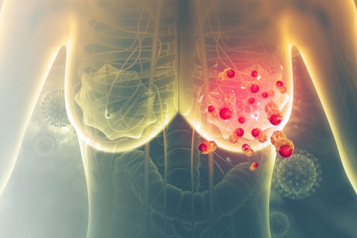 Breast-Cancer-1138405349-scaled