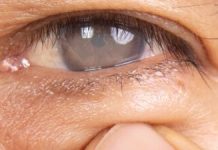 Cum un regulator al stresului oxidativ agravează cataracta