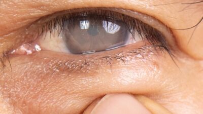 Cataracts-400x225
