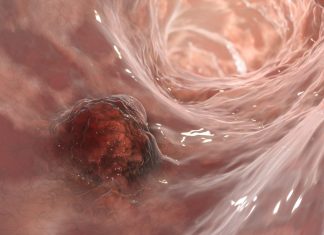 Strategii Avansate de Imunoterapie Pot Îmbunătăți Tratamentul Cancerului Colorectal 0 (0)