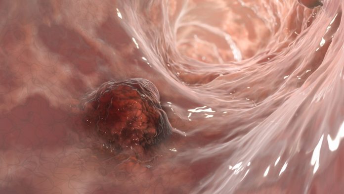 Colon-Cancer-1319439468-e1660768507390
