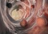 O procedură unică poate reduce riscul de cancer colorectal pe termen lung