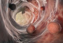 O procedură unică poate reduce riscul de cancer colorectal pe termen lung
