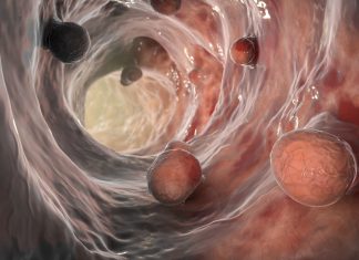 O procedură unică poate reduce riscul de cancer colorectal pe termen lung 5 (1)