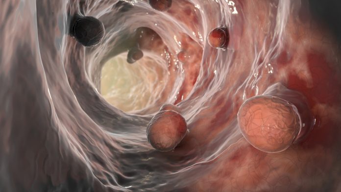 Colorectal-cancer-1339204805