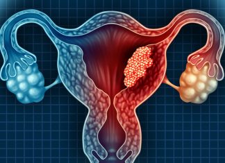 O nouă speranță în tratamentul cancerului uterin dificil de tratat 0 (0)