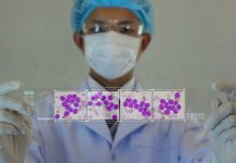 Diversitatea Celulelor Stem în Leucemie Accentuează Rezistența la Tratament în AML