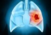 Celulele canceroase își modifică mediul înconjurător pentru a forma tumori